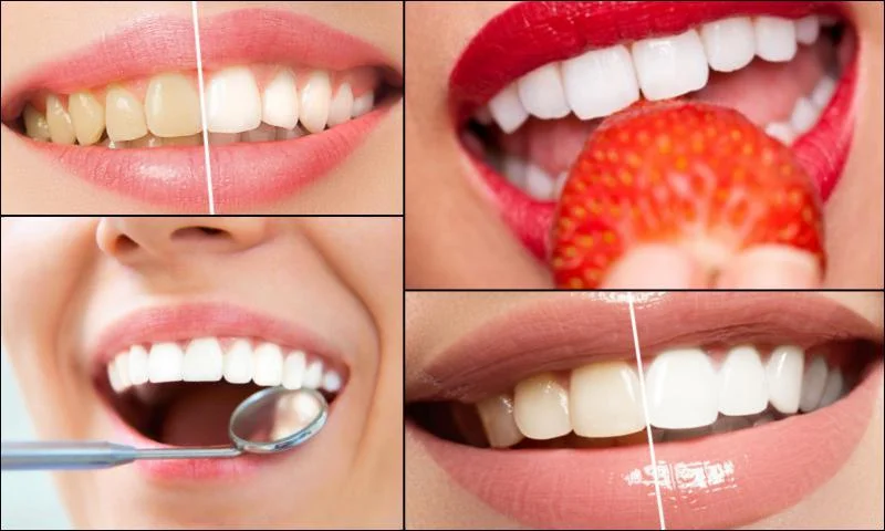 Diş Kaplaması Çeşitleri 