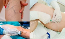 Varis Nedir ve Neden Oluşur?