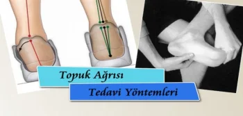 Topuk Ağrısı Tedavi Yöntemleri