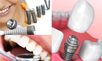 İmplant Tedavisi Avantajları Nelerdir ve Neden Tercih Edilir?