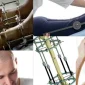 Cheapest Limb Lengthening Surgery En Ucuz Uzuv Uzatma Ameliyatı