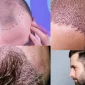 İstanbul’da Saç Ekimi - Hair Transplant in İstanbul Fiyatları Ne Kadar?